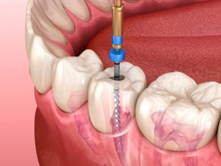 Endodoncia